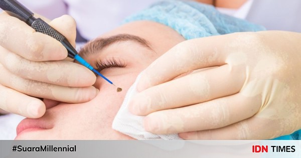 Cara Menghilangkan Tahi Lalat Yang Aman Dan Minim Risiko Cara Menghilangkan Tahi Lalat Yang Aman Dan Minim Risiko