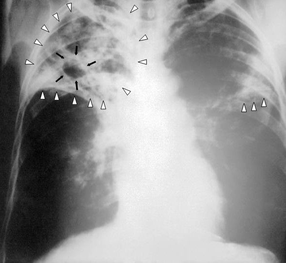 Akses Medis Minim Selama Pandemik, Penderita TBC Diselimuti Ketakutan 