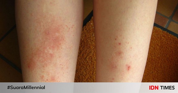 Neurodermatitis Tanda Dan Gejala Penyebab Cara Mengobati Cara Mencegah