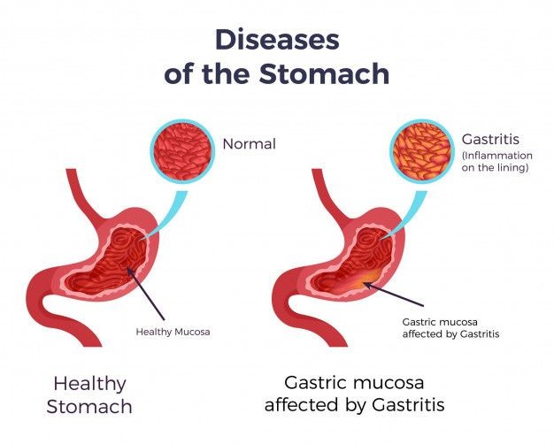 Gastritis Jenis Penyebab Gejala Diagnosis Pengobatan