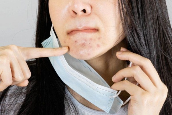 10 Cara Ampuh Mencegah Maskne, Jerawat Bandel akibat Pakai Masker