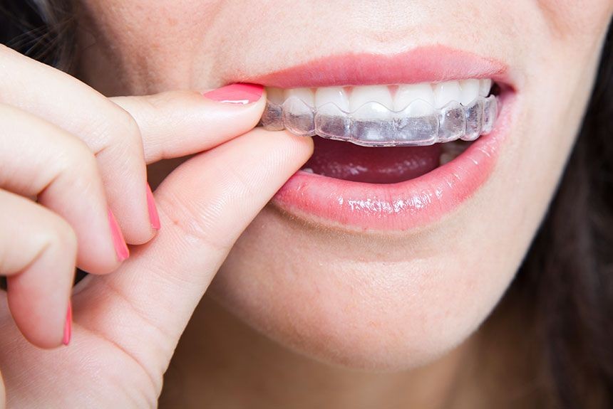 5 Kelebihan Aligner  untuk Meratakan Gigi  Lebih Baik 