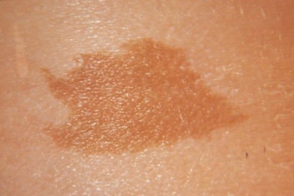Mengenal Neurofibromatosis, Kondisi Tumbuhnya Tumor di Jaringan Saraf