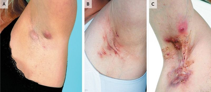 Hidradenitis Suppurativa, Benjolan Menyakitkan di Area Lipatan Kulit