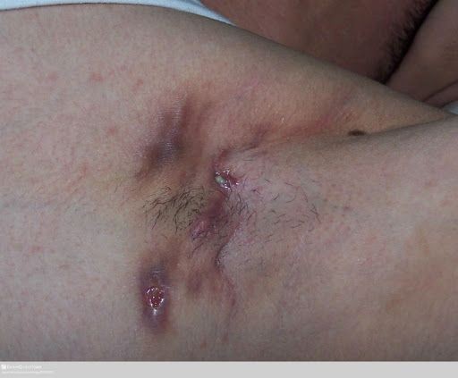 Hidradenitis suppurativa (HS)
