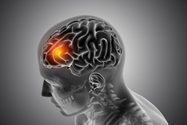 migrain tanda awal kerusakan otak