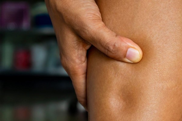 Bekas Kulit Gak Balik setelah Ditekan? Waspadai Pitting Edema