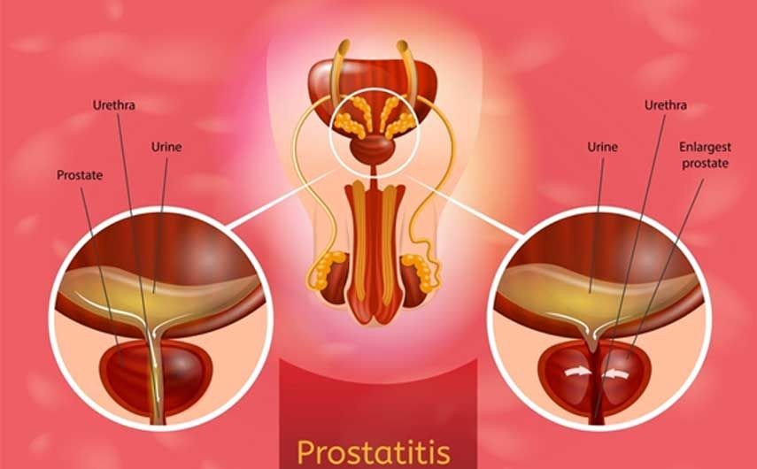 prostatitis prosztatit