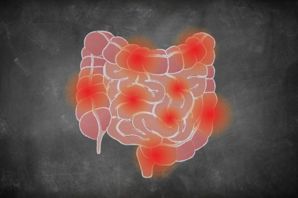 Perdarahan Rektal dan Fisura Anus? Mungkin Itu Gejala Penyakit Crohn