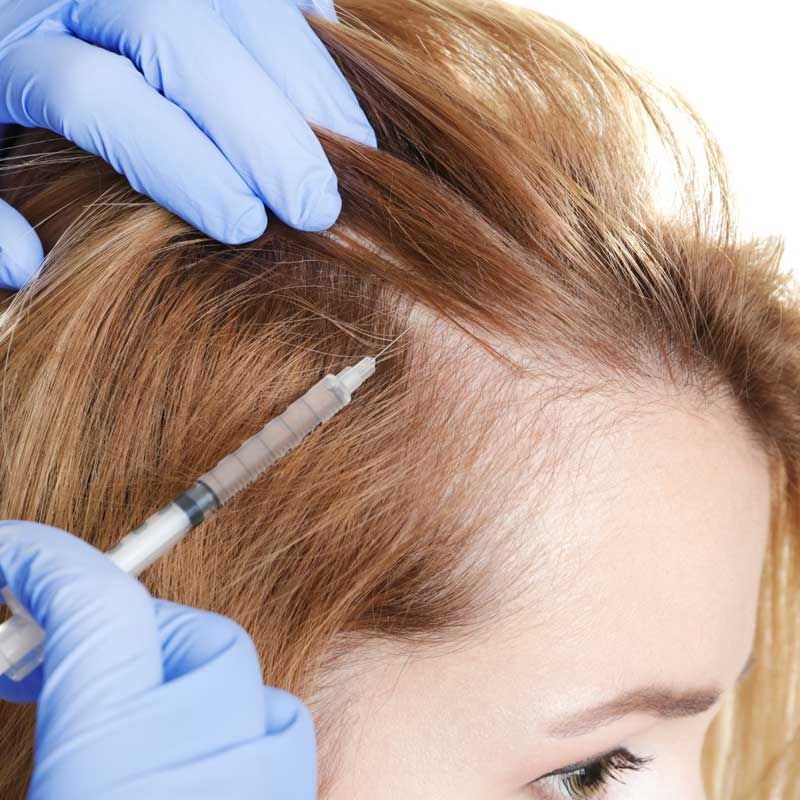 Alopecia Areata: Gejala, Jenis, Penyebab, dan Pengobatan