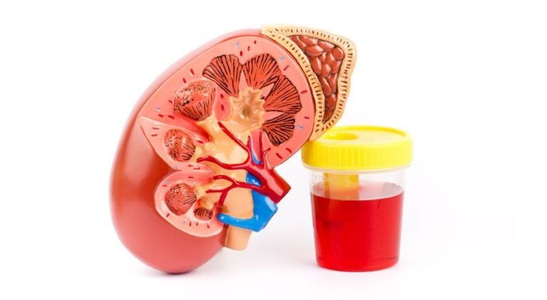 Kenali Hematuria, Bikin Urine Berwarna Merah seperti Darah atau Teh 