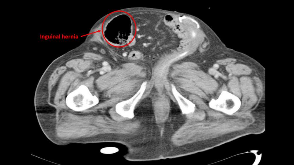 Hernia Inguinalis: Penyebab, Gejala, Dan Pengobatan