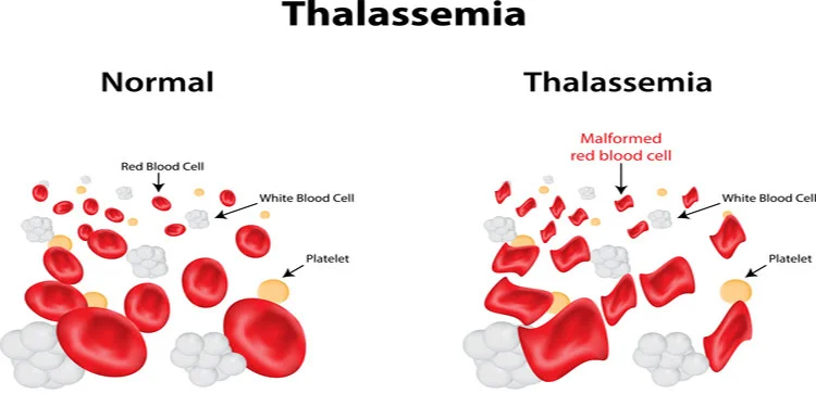bentuk sel darah penderita thalassemia
