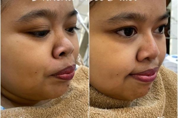 Pangling Gak? 10 Potret Kekeyi Sebelum dan Sesudah Filler Hidung