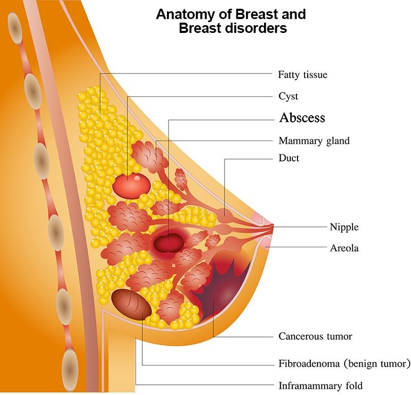 Sering Dialami Ibu Menyusui, Ini 5 Fakta seputar Abses Payudara