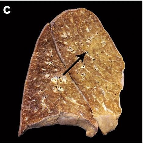 Ngeri 10 Foto Organ Tubuh Yang Terkena Covid 19 Berat