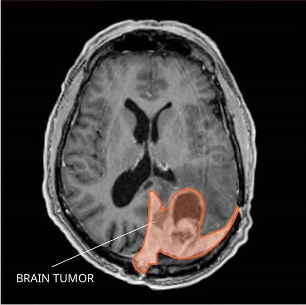 7 Jenis Tumor Jinak Yang Sering Muncul Di Tubuh Kenali