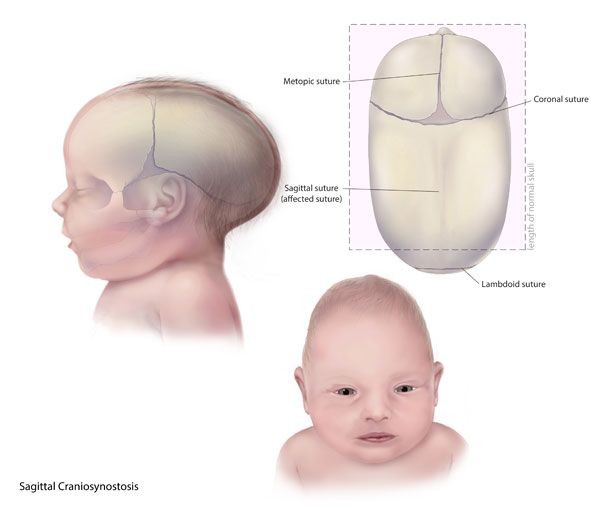 Craniosynostosis Penyebab Gejala Komplikasi Penanganan