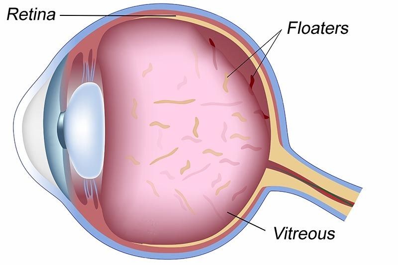 Floaters Mata: Penyebab, Gejala, Diagnosis, dan Pengobatan