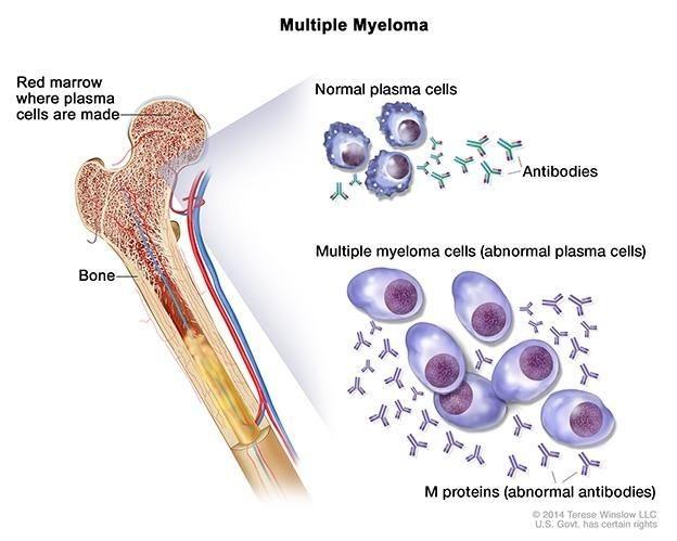 Multiple Myeloma: Penyebab, Gejala, Diagnosis, Pengobatan