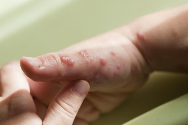 Epidermolisis Bulosa: Penyebab, Gejala, Diagnosis, dan Pengobatan