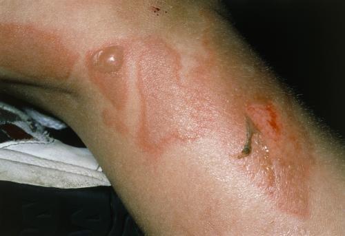 Apa Itu Staphylococcal Scalded Skin Syndrome