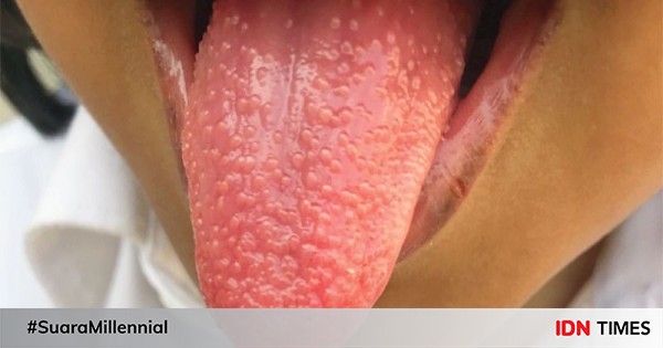 Lidah Stroberi Penyebab Gejala Diagnosis Dan Pengobatan