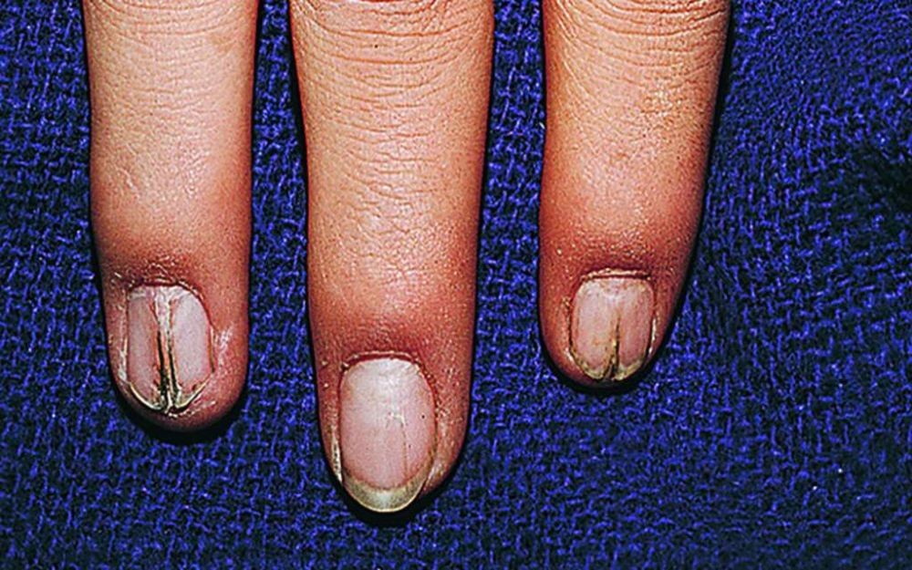 Solved Nail-patella syndrome is an autosomal disorder | Chegg.com