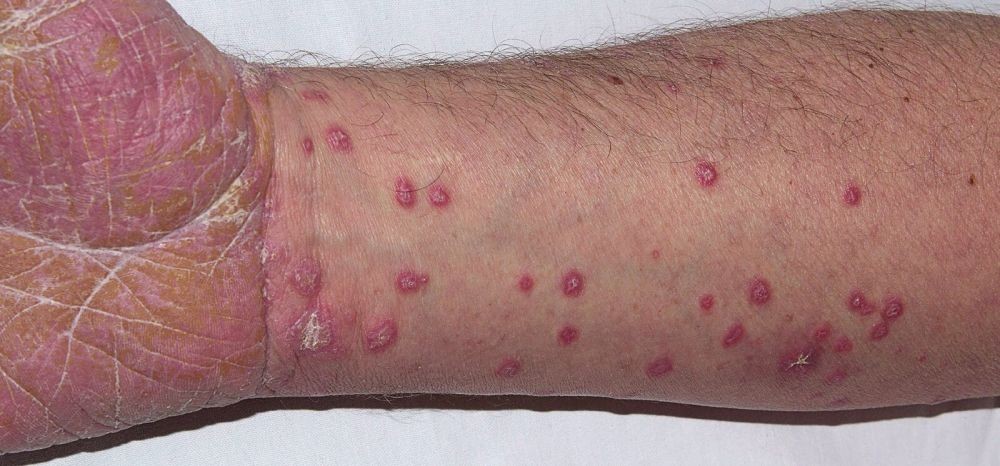 Lichen Planus Penyebab Gejala Komplikasi Pengobatan