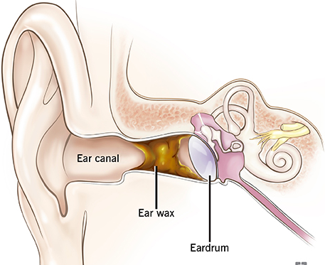 Como sacar un objeto del oido