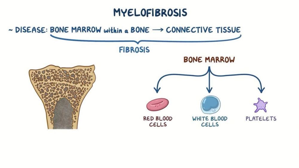 Myelofibrosis: Penyebab, Gejala, Diagnosis, Dan Pengobatan