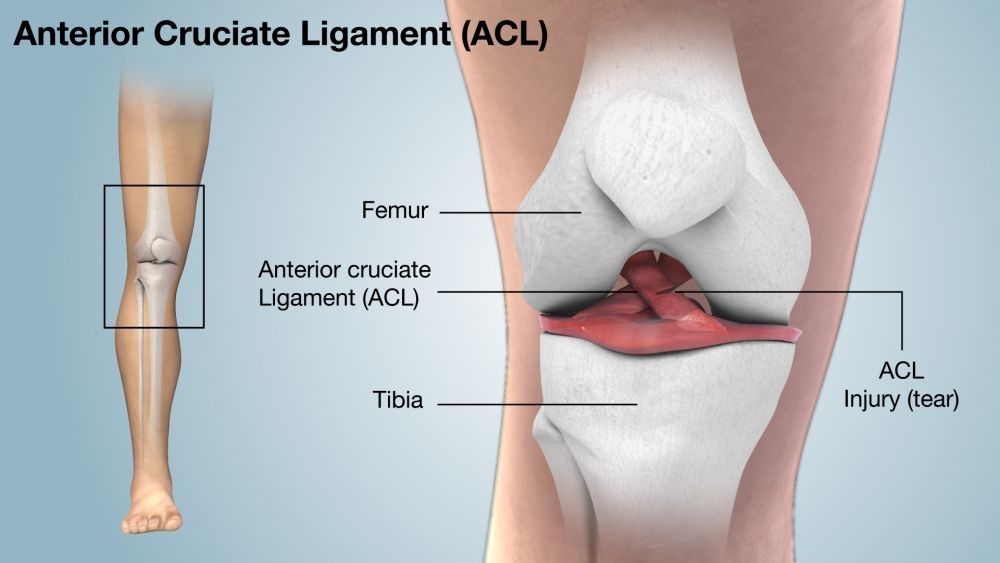 Cedera Ligamen Lutut Anterior Penyebab Gejala Pengobatan 0659