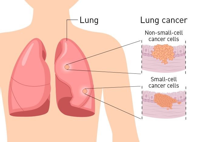 Kanker Paru-Paru, Penyebab Utama Kematian akibat Kanker di Indonesia