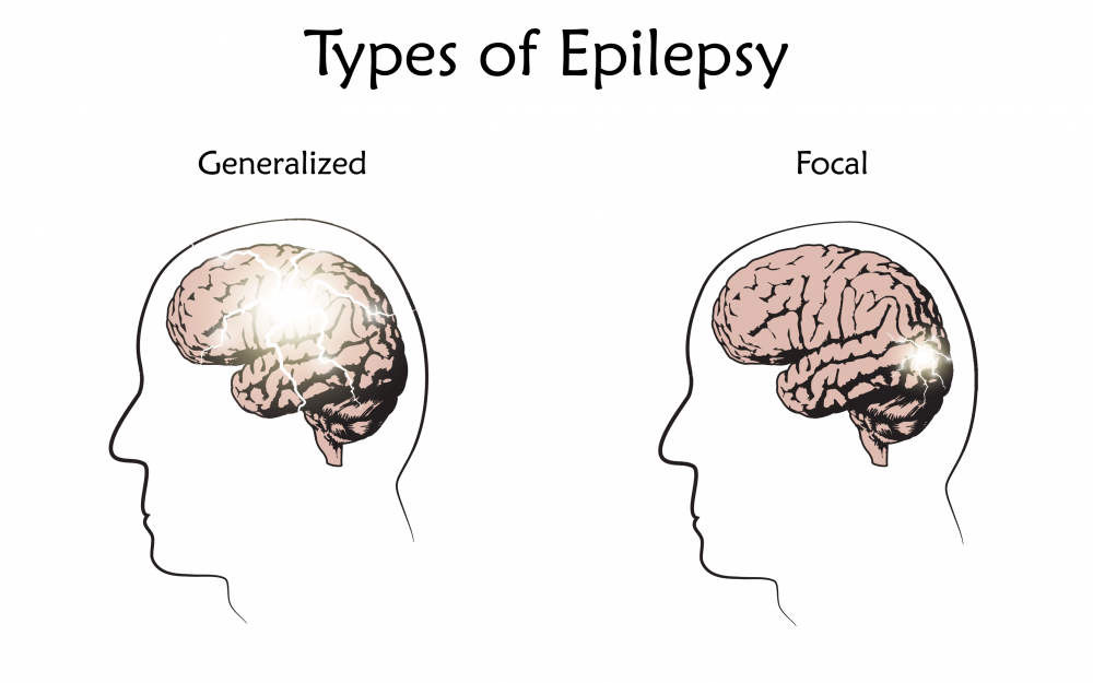 Epilepsi: Jenis, Penyebab, Gejala, Pengobatan