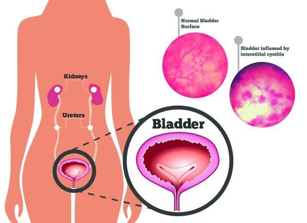 cystitis-penyebab-gejala-pengobatan-dan-pencegahan