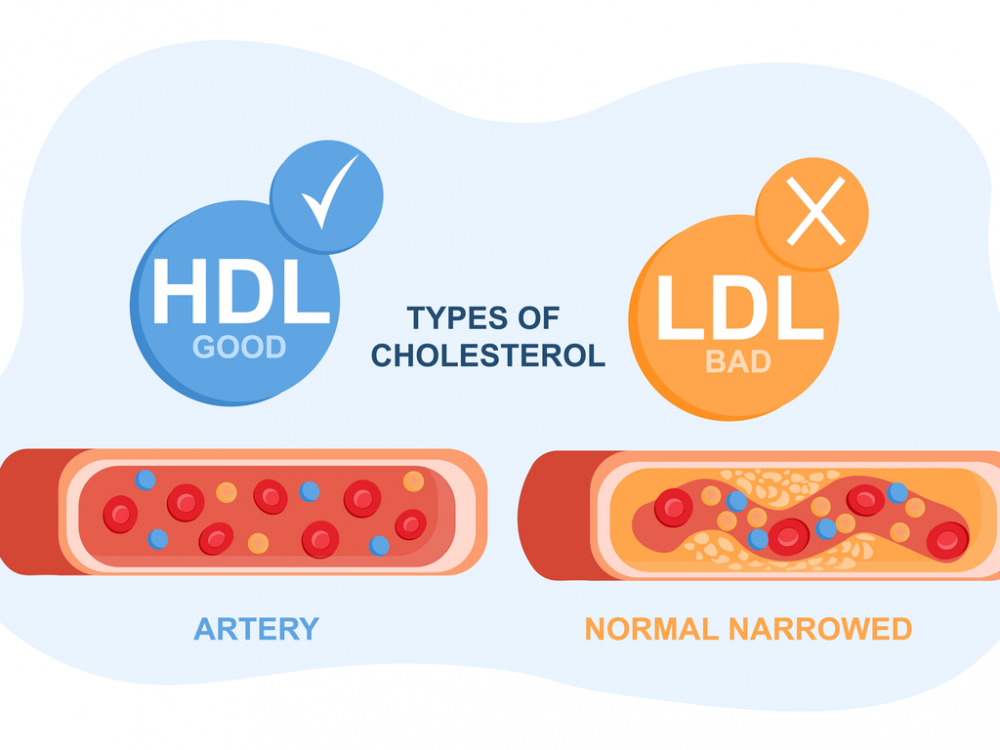 Tak Mengenal Usia, Ini 5 Tanda Kolesterol Naik dan Cara Mengatasinya
