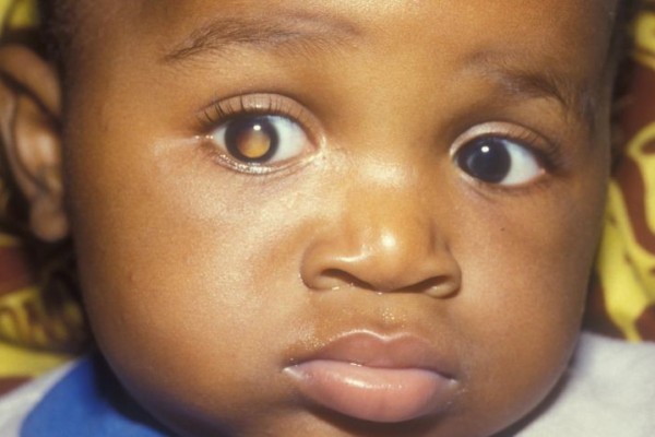 Retinoblastoma: Penyebab, Gejala, Komplikasi, dan Pengobatan
