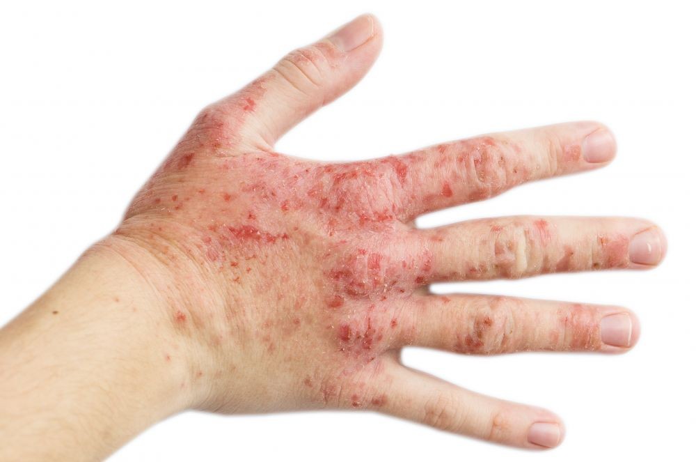 Dermatitis Atopik Gejala Penyebab Pengobatan Komplikasi
