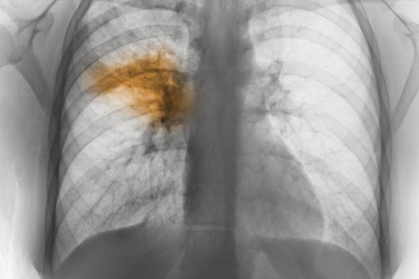 Pneumonia: Gejala, Penyebab, Komplikasi, Dan Pengobatan