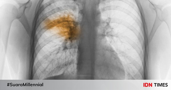 Pneumonia: Gejala, Penyebab, Komplikasi, Dan Pengobatan