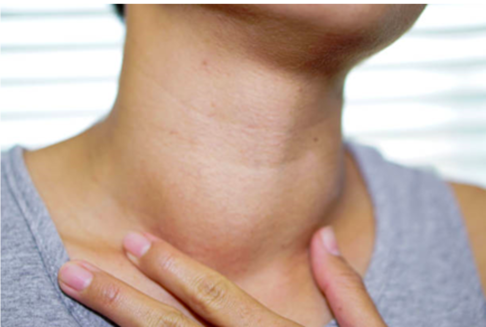 Hipotiroidisme Penyebab Gejala Diagnosis Dan Pengobatan