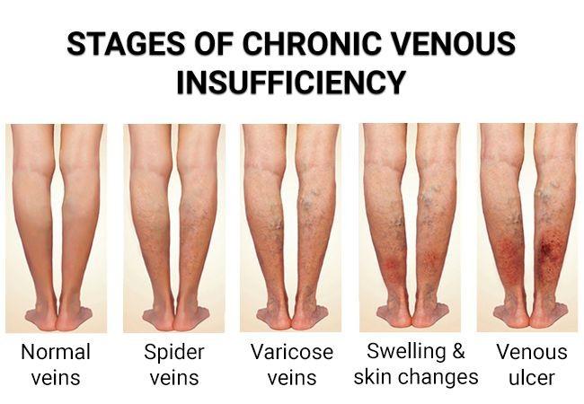 chronic-venous-insufficiency-penyebab-gejala-pengobatan