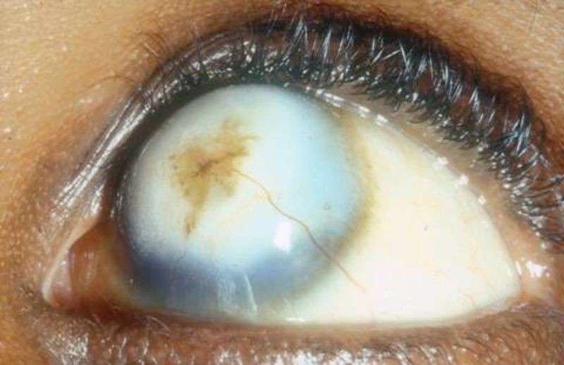 Xerophthalmia: Gejala, Penyebab, Pengobatan, Dan Pencegahan