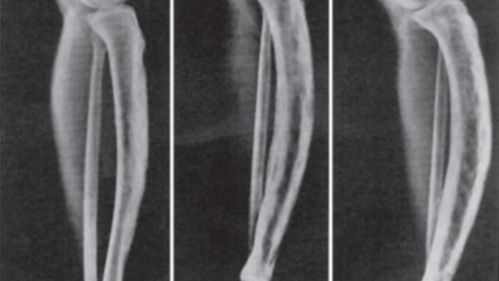 Penyakit Paget Tulang: Gejala, Penyebab, dan Pengobatan