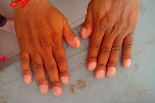 Clubbing Finger: Penyebab, Gejala, Diagnosis, dan Pengobatan