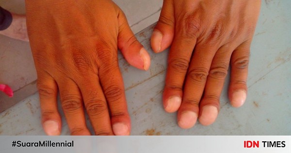 clubbing-finger-penyebab-gejala-diagnosis-dan-pengobatan
