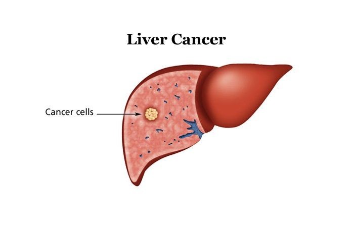 Hepatitis c se puede curar