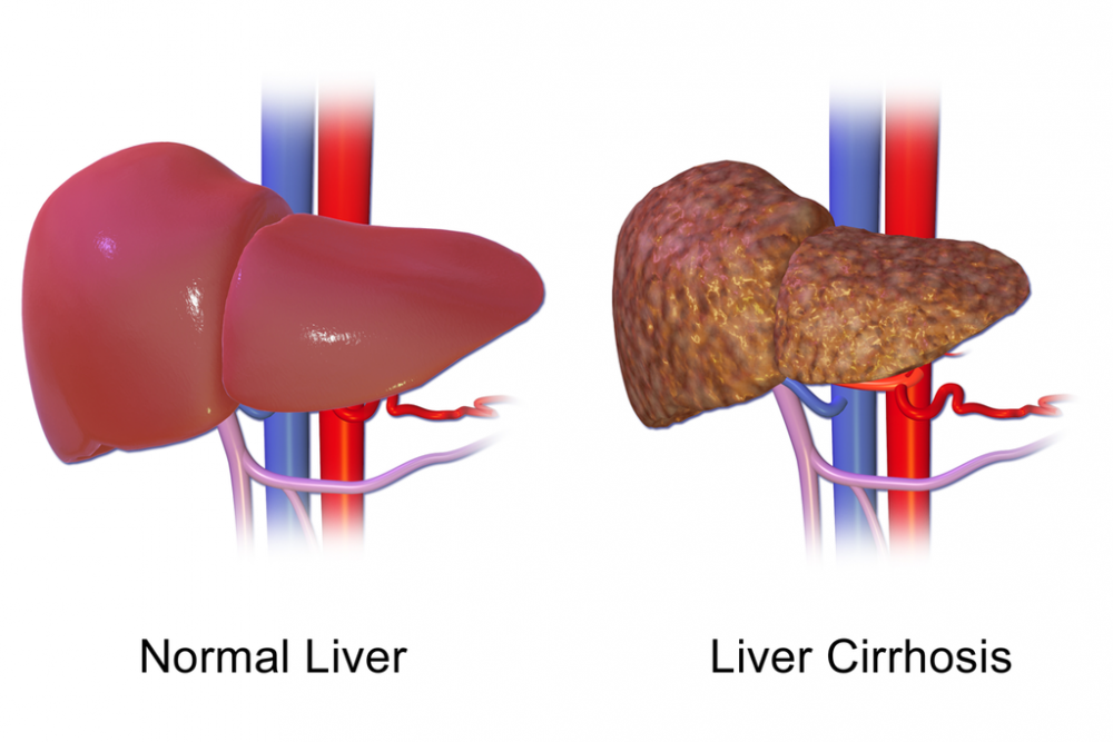 Hepatitis B: Penyebab, Gejala, Pengobatan, Dan Pencegahan