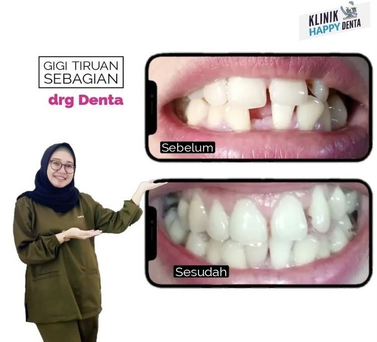 Harga Pasang Behel di 5 Klinik Gigi Lampung, Ada Beri Promo Maret Ini!