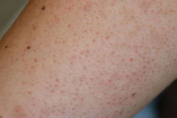 Keratosis Pilaris: Penyebab, Gejala, Diagnosis, Penanganan